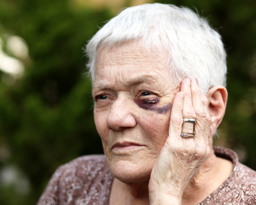 An elderly woman with a bruise under her eye looks distressed while touching her face, representing signs of nursing home abuse and neglect in Oklahoma City.